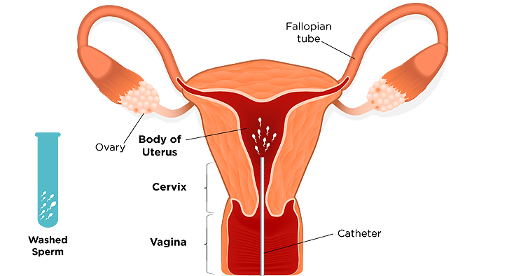 intrauterine insemination iui